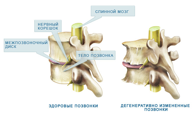 Лечение деформирующего остеоартроза